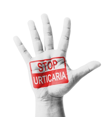Urticaria